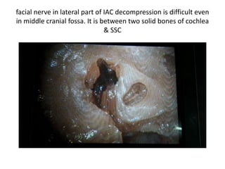 facial nerve in lateral part of IAC decompression is difficult even in middle
cranial fossa. It is between two solid bones of cochlea & SSC
 