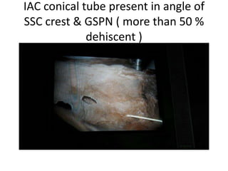 IAC [ Internal Auditory Canal ]
Drilling
 