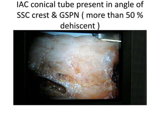 IAC conical tube present in angle of
SSC crest & GSPN ( more than 50 %
dehiscent )
 