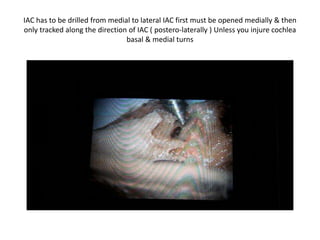 IAC conical tube present in angle of
SSC crest & GSPN ( more than 50 %
dehiscent )
 