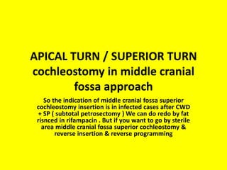 Middle cranial fossa
approach for
Cochlear implant
 