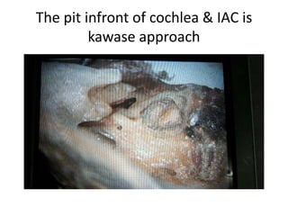The pit infront of cochlea & IAC is
kawase approach
 
