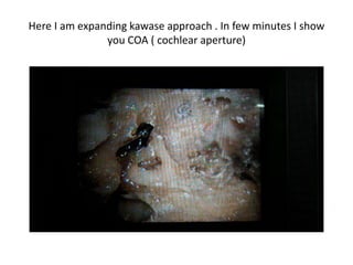 The pit infront of cochlea & IAC is
kawase approach
 