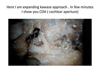 Here I am expanding kawase approach . In few minutes I show
you COA ( cochlear aperture)
 