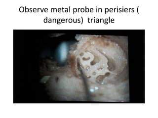 Probing in middle turn
 