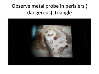 Observe metal probe in perisiers (
dangerous) triangle
 