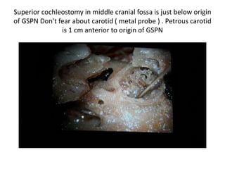 APICAL TURN / SUPERIOR TURN
cochleostomy in middle cranial
fossa approach
So the indication of middle cranial fossa superior
cochleostomy insertion is in infected cases after CWD
+ SP ( subtotal petrosectomy ) We can do redo by fat
risnced in rifampacin . But if you want to go by sterile
area middle cranial fossa superior cochleostomy &
reverse insertion & reverse programming
 