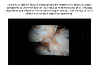 So the metal probe in perisiers triangle goes to the middle turn of cochlea &
exactly corresponds to labyrinthine part of facial nerve So middle turn array
of CI stimulates labyrinthine part of facial nerve causing twitchings in post-op
. Then we have to switch off those electrodes in software programming .
 