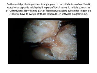 So the metal probe in perisiers triangle goes to the middle turn of cochlea & exactly
corresponds to labyrinthine part of facial nerve So middle turn array of CI stimulates
labyrinthine part of facial nerve causing twitchings in post-op . Then we have to switch
off those electrodes in software programming .
 