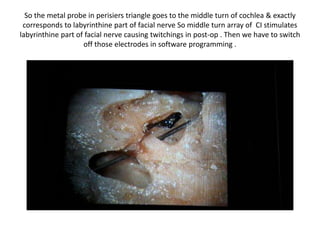 So the metal probe in perisiers triangle goes to the middle turn of cochlea &
exactly corresponds to labyrinthine part of facial nerve So middle turn array
of CI stimulates labyrinthine part of facial nerve causing twitchings in post-op
. Then we have to switch off those electrodes in software programming .
 