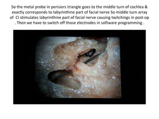 So the metal probe in perisiers triangle goes to the middle turn of cochlea & exactly
corresponds to labyrinthine part of facial nerve So middle turn array of CI stimulates
labyrinthine part of facial nerve causing twitchings in post-op . Then we have to switch
off those electrodes in software programming .
 