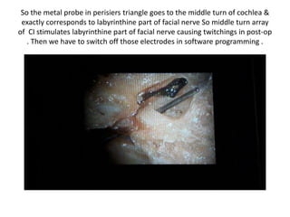 So the metal probe in perisiers triangle goes to the middle turn of cochlea &
exactly corresponds to labyrinthine part of facial nerve So middle turn array
of CI stimulates labyrinthine part of facial nerve causing twitchings in post-op
. Then we have to switch off those electrodes in software programming .
 
