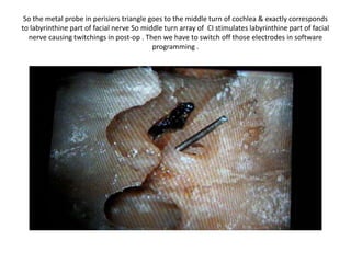 So the metal probe in perisiers triangle goes to the middle turn of cochlea &
exactly corresponds to labyrinthine part of facial nerve So middle turn array
of CI stimulates labyrinthine part of facial nerve causing twitchings in post-op
. Then we have to switch off those electrodes in software programming .
 
