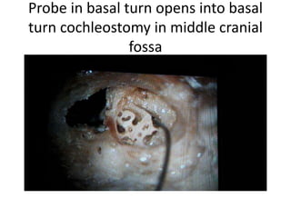 Probing in basal turn
 