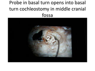 Probe in basal turn opens into basal
turn cochleostomy in middle cranial
fossa
 