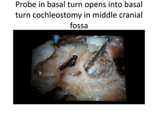 Probe in basal turn opens into basal
turn cochleostomy in middle cranial
fossa
 