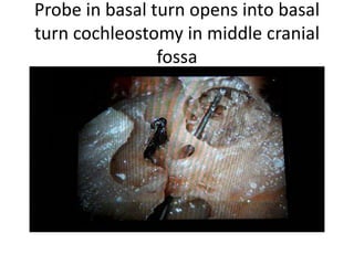 Probe in basal turn opens into basal
turn cochleostomy in middle cranial
fossa
 