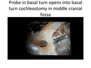 Probe in basal turn opens into basal
turn cochleostomy in middle cranial
fossa
 
