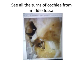 Probe in basal turn opens into basal
turn cochleostomy in middle cranial
fossa
 