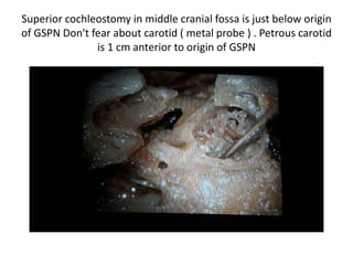 Superior cochleostomy in middle cranial fossa is just below origin
of GSPN Don't fear about carotid ( metal probe ) . Petrous carotid
is 1 cm anterior to origin of GSPN
 
