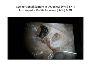 Superior Vestibular nerve ( SVN ) & facial nerve separatedby bills bar , that I
drilled . Observe here SVN & FN converge . Where as IVN & cochlear nerve
diverge ……….. This convergence of SVN & FN very useful in MRI reading
 