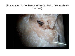 Observe here the IVN & cochlear nerve diverge ( not so clear in
cadaver )
 