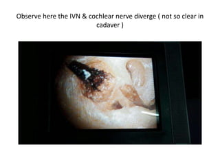 Observe here the IVN & cochlear nerve diverge ( not so clear in
cadaver )
 