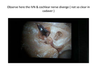 Observe here the IVN & cochlear nerve diverge ( not so clear in
cadaver )
 
