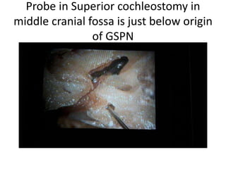 Superior cochleostomy in middle cranial fossa is just below origin
of GSPN Don't fear about carotid ( metal probe ) . Petrous carotid
is 1 cm anterior to origin of GSPN
 