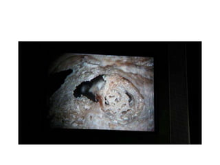 Cochlear implant
after
Translabyrinthine
approach
 