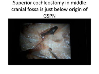 Probe in Superior cochleostomy in
middle cranial fossa is just below origin
of GSPN
 