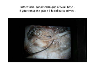 PSC is deeper than LSC & SSC is deeper
than PSC
 