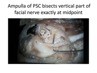 Intact facial canal technique of Skull base .
If you transpose grade 3 facial palsy comes .
 