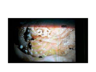 Bills bar between FN & SVN
 