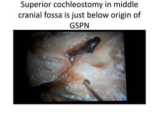 Superior cochleostomy in middle
cranial fossa is just below origin of
GSPN
 