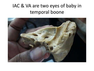 IAC & VA are two eyes of baby in
temporal boone
 