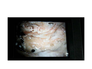 IAC & VA are two eyes of baby in
temporal boone
 