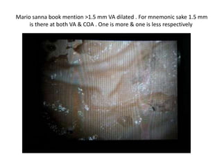 Endolymphatic duct & Vestibular aqueduct both are same or not ........ I have to refer .
....... but clearly there is duct from vestibule to endolymphatic sac area . If it is more
than 1.5 mm it is " dilated Vestibular aqueduct " Another 1.5mm is ........, if COA (
cochlear aperture ) less than 1.5mm it is cochlear nerve aplasia.
 