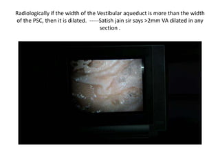 Mario sanna book mention >1.5 mm VA dilated . For mnemonic sake 1.5 mm
is there at both VA & COA . One is more & one is less respectively
 