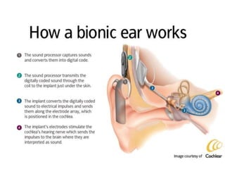 Cochlear Implementation COCHLEAR IMPLANTATION over view | PPTX