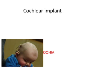 Cochlear implant
DR.ROOHIA
 