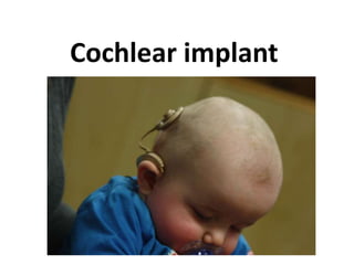 Cochlear implant

 