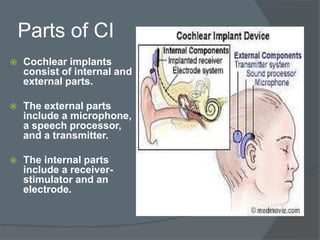 Parts of CI
 Cochlear implants
consist of internal and
external parts.
 The external parts
include a microphone,
a speech processor,
and a transmitter.
 The internal parts
include a receiver-
stimulator and an
electrode.
 
