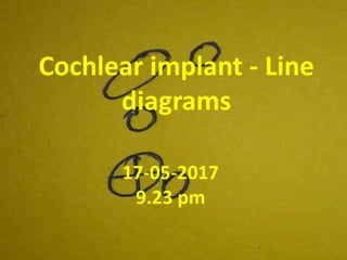 Cochlear implant - Line
diagrams
22-06-2017
2.32 pm
 