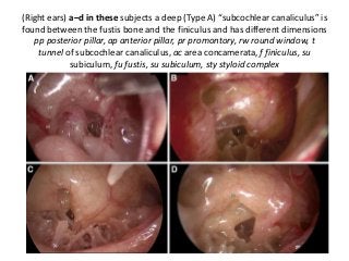 (Right ears) a–d in these subjects a deep (Type A) “subcochlear canaliculus” is
found between the fustis bone and the finiculus and has different dimensions
pp posterior pillar, ap anterior pillar, pr promontory, rw round window, t
tunnel of subcochlear canaliculus, ac area concamerata, f finiculus, su
subiculum, fu fustis, su subiculum, sty styloid complex
 
