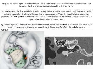 (Right ears) Three types of conformations of the round window chamber related to the relationship
between the fustis, area concamerata and the finiculus bone.
Type A between the fustis and the finiculus a deep hole/tunnel is present with deep extension to the
petrous apex cells lying below the cochlea; in these cases a CT scan in a sagittal view shows the
presence of a well pneumatized temporal bone at the most inferior and medial portion of the petrous
apex below the internal auditory canal.
pp posterior pillar, ap anterior pillar, rw round window, red arrow tunnel of subcochlear canaliculus, ac
area concamerata, f finiculus, su subiculum, fu fustis, su subiculum, sty stylod complex
 