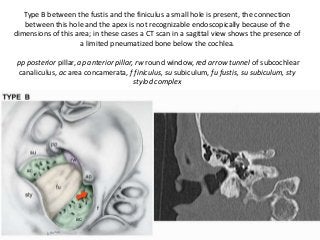 Type B between the fustis and the finiculus a small hole is present, the connection
between this hole and the apex is not recognizable endoscopically because of the
dimensions of this area; in these cases a CT scan in a sagittal view shows the presence of
a limited pneumatized bone below the cochlea.
pp posterior pillar, ap anterior pillar, rw round window, red arrow tunnel of subcochlear
canaliculus, ac area concamerata, f finiculus, su subiculum, fu fustis, su subiculum, sty
stylod complex
 