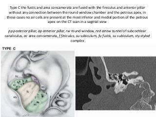 Type C the fustis and area concamerata are fused with the finiculus and anterior pillar
without any connection between the round window chamber and the petrous apex, in
these cases no air cells are present at the most inferior and medial portion of the petrous
apex on the CT scan in a sagittal view
pp posterior pillar, ap anterior pillar, rw round window, red arrow tunnel of subcochlear
canaliculus, ac area concamerata, f finiculus, su subiculum, fu fustis, su subiculum, sty stylod
complex
 