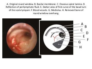 A. Original round window. B. Basilar membrane. C. Osseous spiral lamina. D.
Reflection of perilymphatic fluid. E. Darker area of first curve of the basal turn
of the scala tympani. F. Blood vessels. G. Modiolus. H. Removed bone of
round window overhang.
 