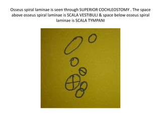 The round inferior to Antero-inferior cochleostomy is
INFERIOR COCHLEOSTOMY , which is direct trajectory
to scala tympani
 